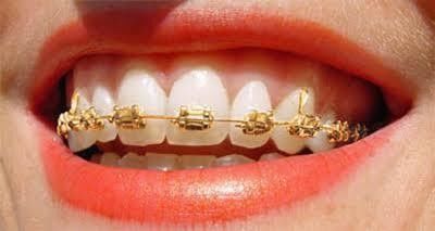 0.022/0.018 Tamaño de ranura DTC Ortodoncia Dental Brackets Revestidos de Oro Brace Tejido Ortopédico