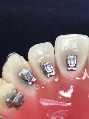 Clínica Tubos molares Brackets lingüísticos dentales para ortodoncia DTC Bracket autoligado