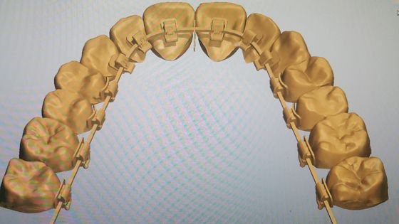 Fuente de maquinaria poderosa DTC Ortodoncia Brackets de la lengua con brackets autoligantes